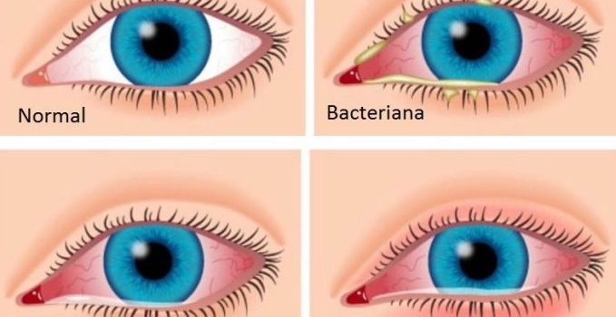 Conjuntivitis alérgicas y bacterianas