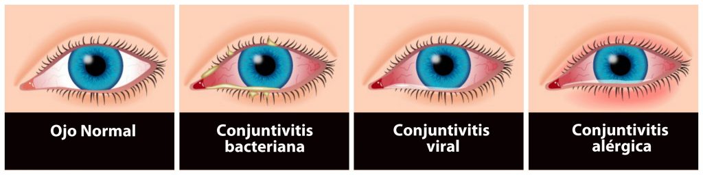 Conjuntivitis Alérgicas Y Bacterianas Pediatría Palermo 0191